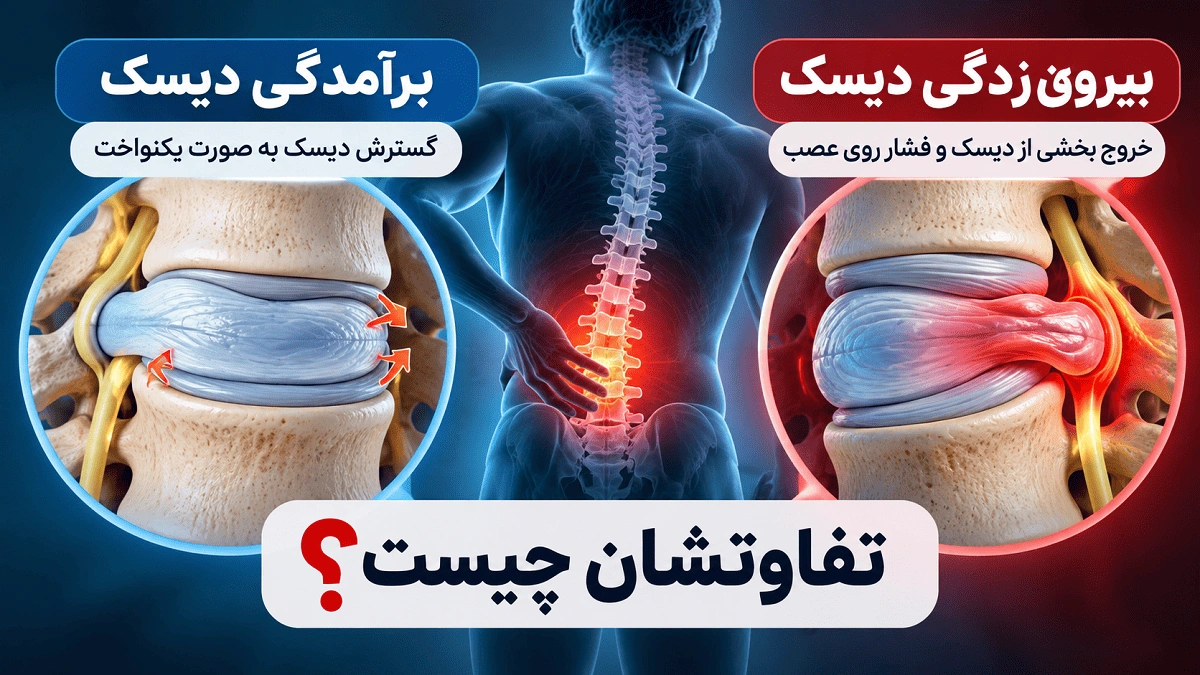 فرق برآمدگی دیسک با بیرون‌زدگی دیسک چیست؟ تفاوتی که خیلی‌ها اشتباه می‌گیرند