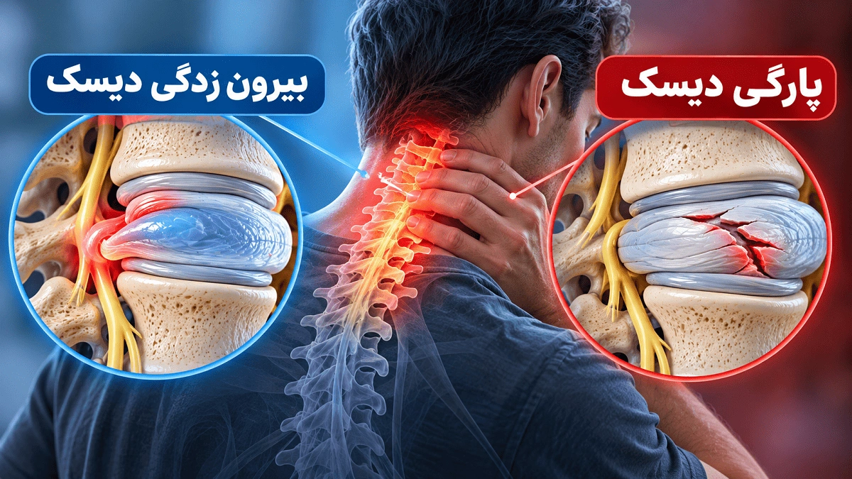 فرق پارگی دیسک گردن با بیرون زدگی دیسک چیست؟ کدام جدی‌تر است؟