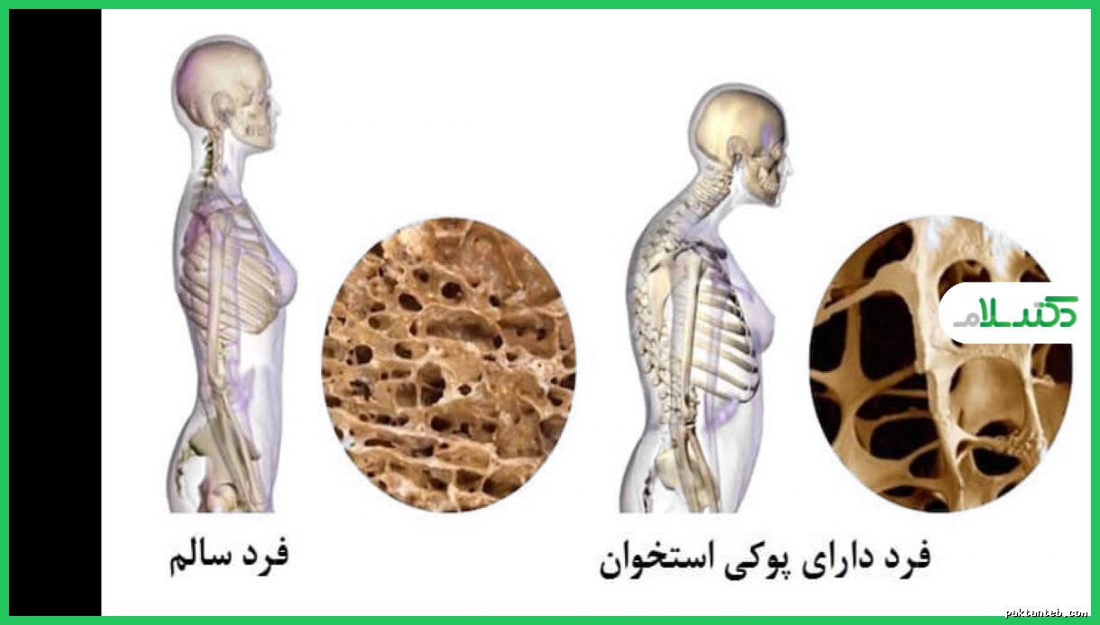 تأثیر کمبود وزن بر سلامت استخوان و روش‌های جلوگیری از آن