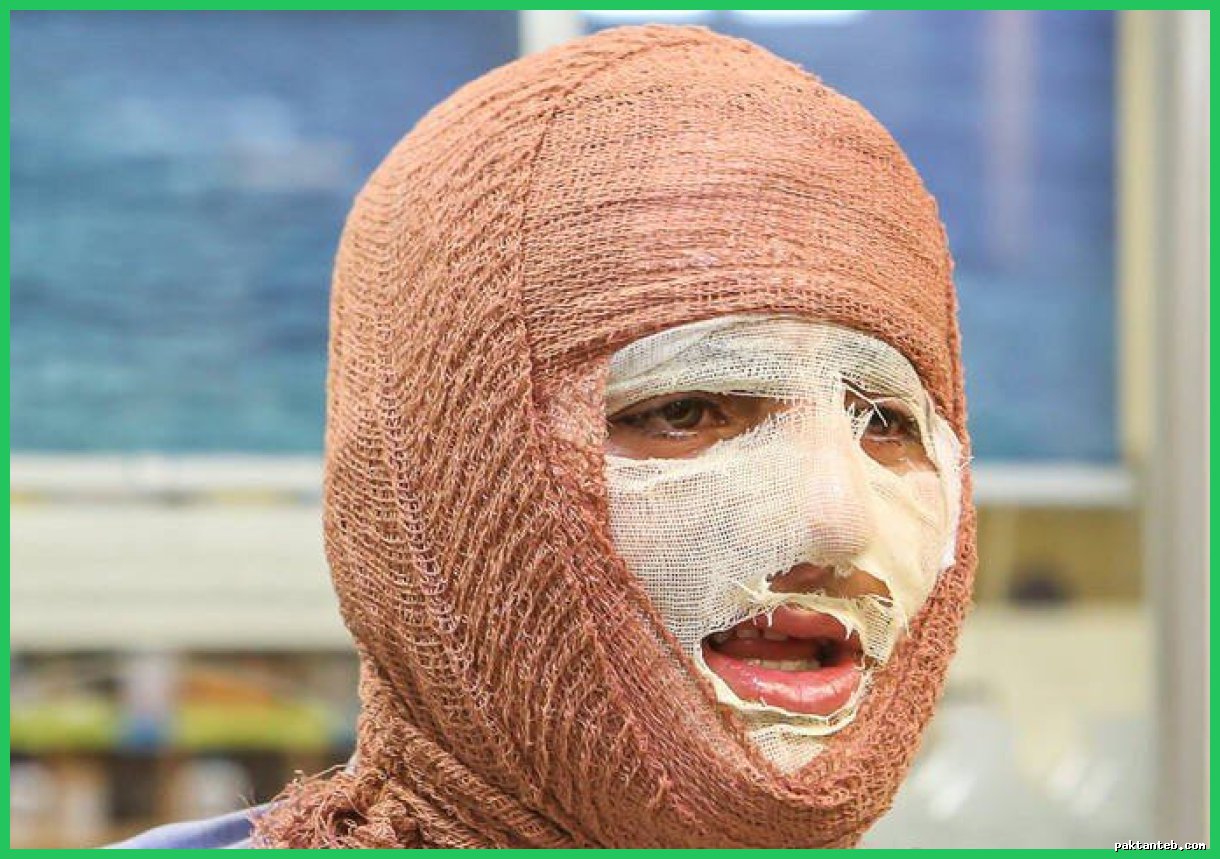 پیشگیری از ۸۵ درصد سوختگی‌ها با روش‌های ساده ممکن است